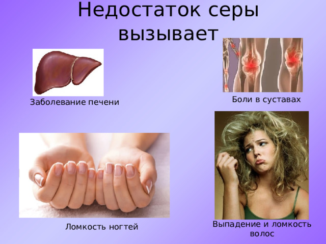 Недостаток серы вызывает Боли в суставах Заболевание печени Выпадение и ломкость волос Ломкость ногтей 