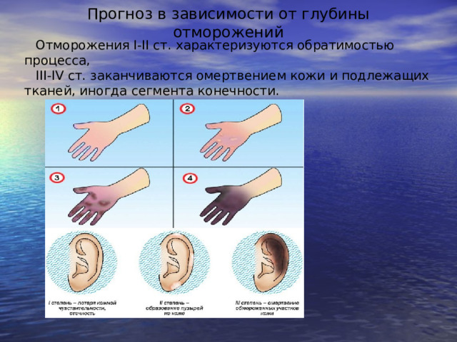 Прогноз в зависимости от глубины отморожений Отморожения I-II ст. характеризуются обратимостью процесса, III-IV ст. заканчиваются омертвением кожи и подлежащих тканей, иногда сегмента конечности. Отморож.Клин.рек. союза комбустиол.2015. 