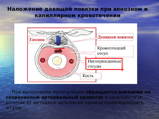 Наложение давящей повязки при венозном и капиллярном кровотечении При выполнении манипуляции обращается внимание на сохраненный артериальный кровоток в конечности (в отличие от методики наложения кровоостанавливающего жгута). 