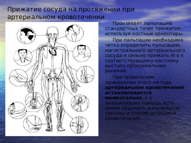 Прижатие сосуда на протяжении при артериальном кровотечении Производят пальпацию стандартных точек прижатия, используя костные ориентиры. При пальпации необходимо четко определить пульсацию магистрального артериального сосуда и сильно прижать его к соответствующему костному выступу проксимальнее ранения. При правильном применении этого метода артериальное кровотечение останавливается моментально , и у оказывающих помощь есть время обдумать дальнейшую тактику и способ остановки кровотечения. 