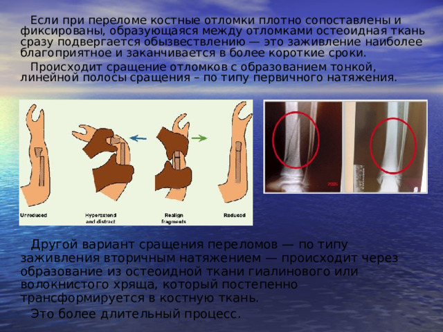 Если при переломе костные отломки плотно сопоставлены и фиксированы, образующаяся между отломками остеоидная ткань сразу подвергается обызвествлению — это заживление наиболее благоприятное и заканчивается в более короткие сроки. Происходит сращение отломков с образованием тонкой, линейной полосы сращения – по типу первичного натяжения. Другой вариант сращения переломов — по типу заживления вторичным натяжением — происходит через образование из остеоидной ткани гиалинового или волокнистого хряща, который постепенно трансформируется в костную ткань. Это более длительный процесс. 