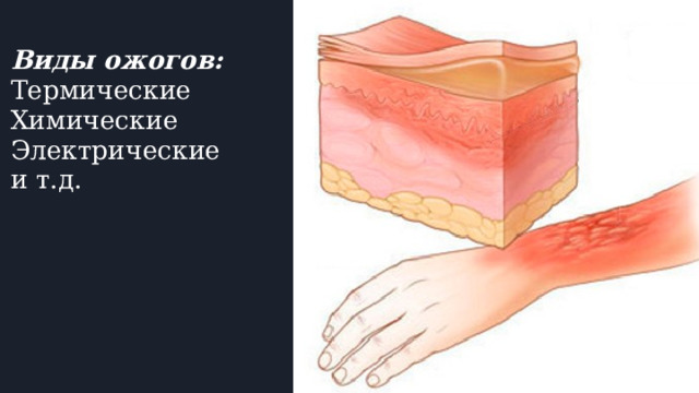 Виды ожогов:  Термические  Химические  Электрические  и т.д. 