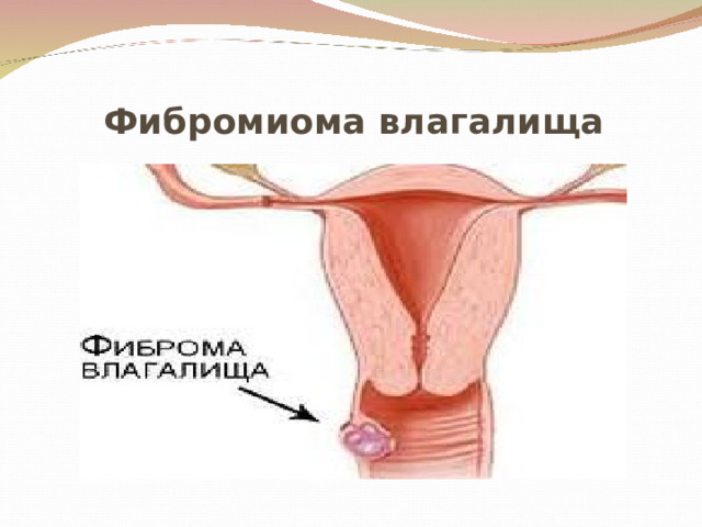 Как выглядит рак вульвы фото Презентация: "Опухоли наружных половых органов"