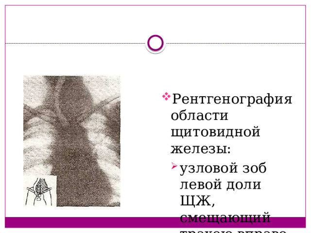 Рентгенография области щитовидной железы: узловой зоб левой доли ЩЖ, смещающий трахею вправо узловой зоб левой доли ЩЖ, смещающий трахею вправо 