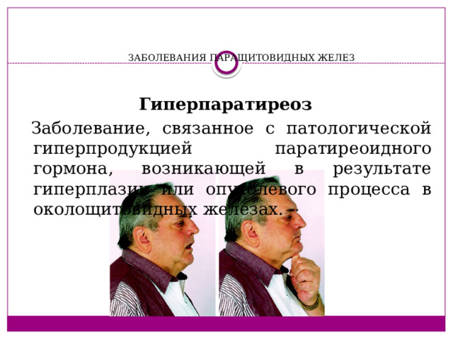 ЗАБОЛЕВАНИЯ ПАРАЩИТОВИДНЫХ ЖЕЛЕЗ     Гиперпаратиреоз  Заболевание, связанное с патологической гиперпродукцией паратиреоидного гормона, возникающей в результате гиперплазии или опухолевого процесса в околощитовидных железах. 