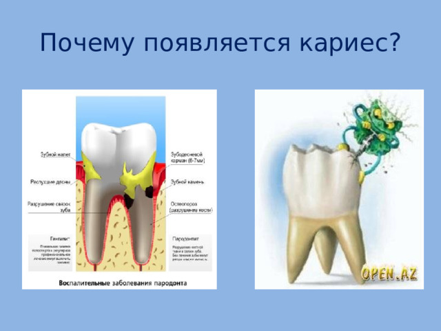 Почему появляется кариес?  