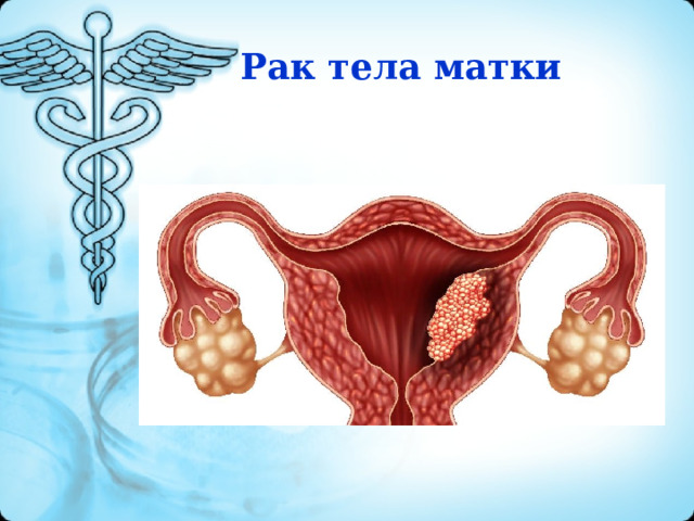 Рак тела матки 