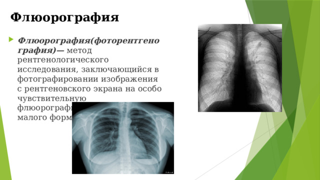 Флюорография Флюорография(фоторентгенография)— метод рентгенологического исследования, заключающийся в фотографировании изображения с рентгеновского экрана на особо чувствительную флюорографическую пленку малого формата. 