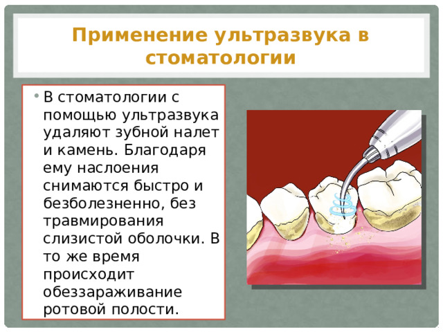 Применение ультразвука в стоматологии В стоматологии с помощью ультразвука удаляют зубной налет и камень. Благодаря ему наслоения снимаются быстро и безболезненно, без травмирования слизистой оболочки. В то же время происходит обеззараживание ротовой полости. 