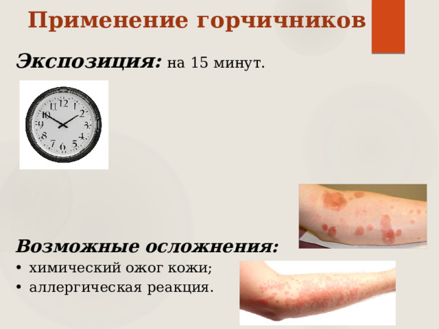 Применение горчичников Экспозиция:  на 15 минут.   Возможные осложнения: химический ожог кожи; аллергическая реакция.  