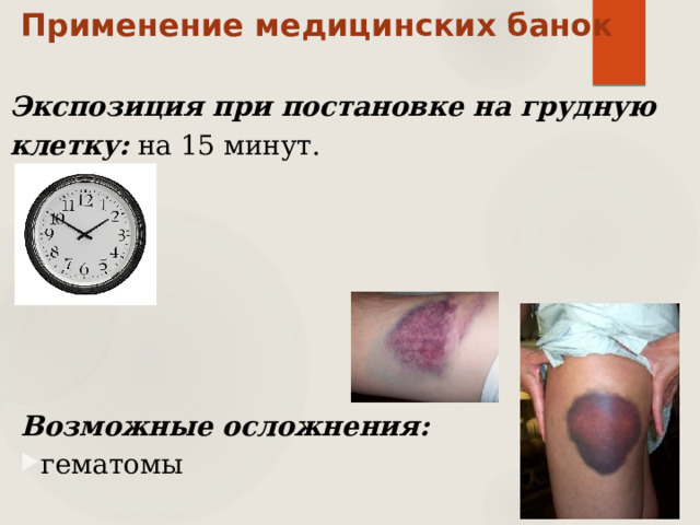 Применение медицинских банок Экспозиция при постановке на грудную клетку:  на 15 минут. Возможные осложнения: гематомы 