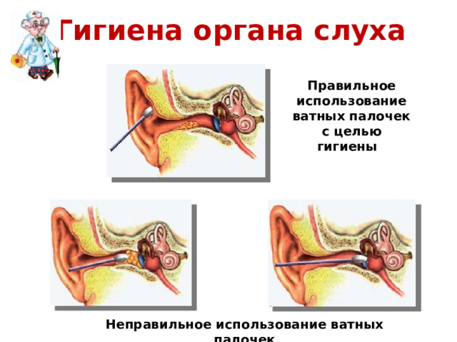 Гигиена органа слуха Правильное использование ватных палочек с целью гигиены Неправильное использование ватных палочек 