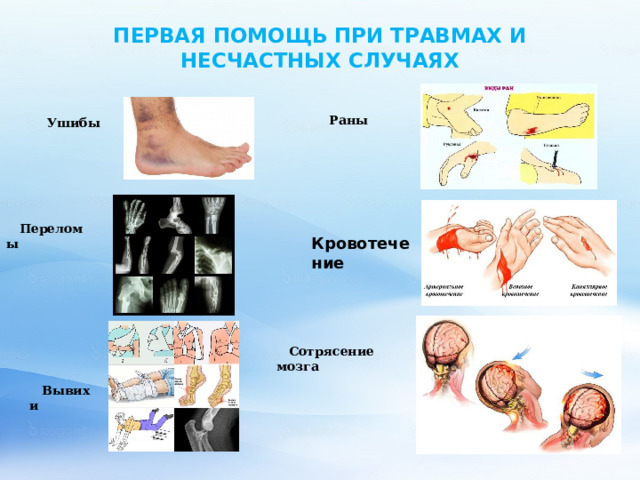 ПЕРВАЯ ПОМОЩЬ ПРИ ТРАВМАХ И НЕСЧАСТНЫХ СЛУЧАЯХ   Раны  Ушибы Переломы Кровотечение  Сотрясение мозга Вывихи 