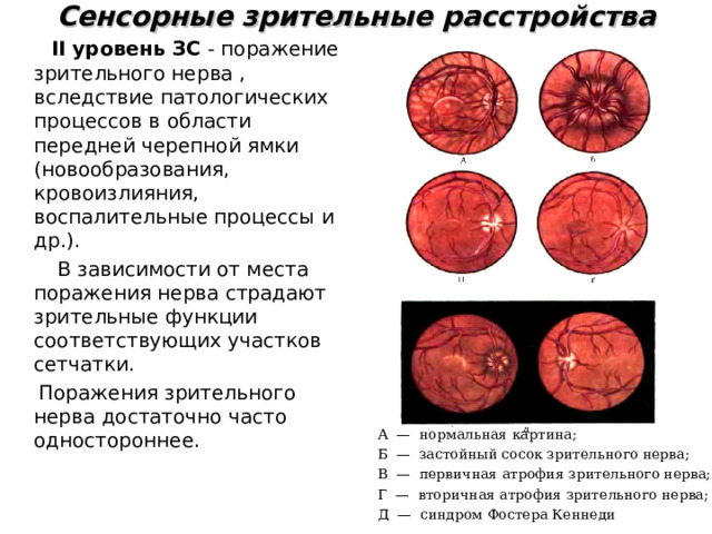 Синдромы зрительных нарушений