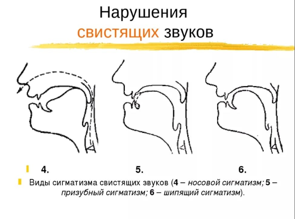 Нарушение артикуляционных схем отдельных звуков является первичным дефектом при