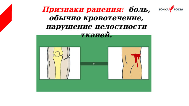 Признаки ранения: боль, обычно кровотечение, нарушение целостности тканей. 
