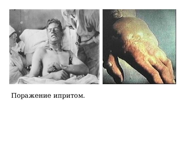 Поражение ипритом. 