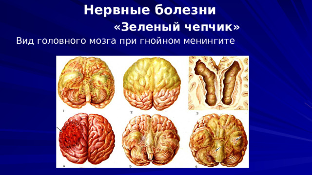 Нервные болезни   «Зеленый чепчик»  Вид головного мозга при гнойном менингите 