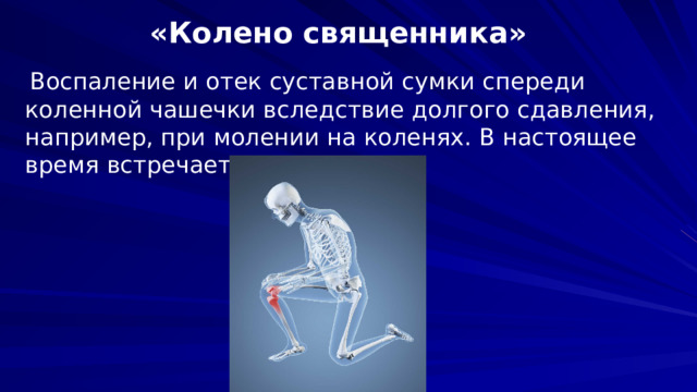 «Колено священника»     Воспаление и отек суставной сумки спереди коленной чашечки вследствие долгого сдавления, например, при молении на коленях. В настоящее время встречается редко.   