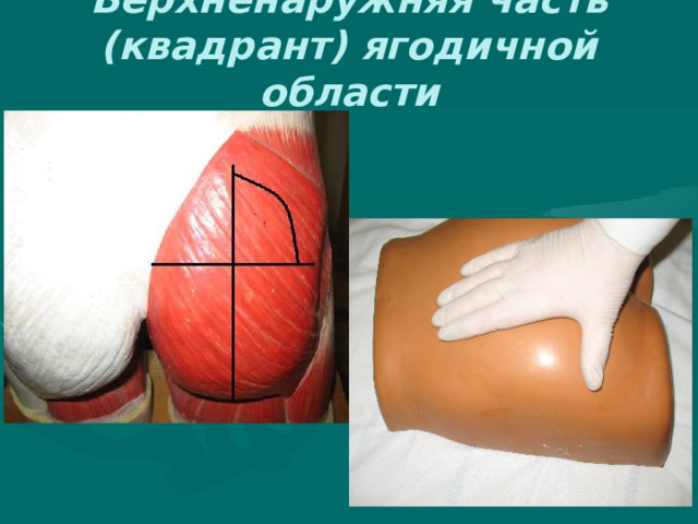 Верхненаружняя часть (квадрант) ягодичной области 