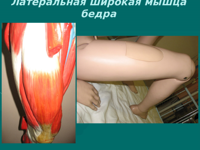 Латеральная широкая мышца бедра 