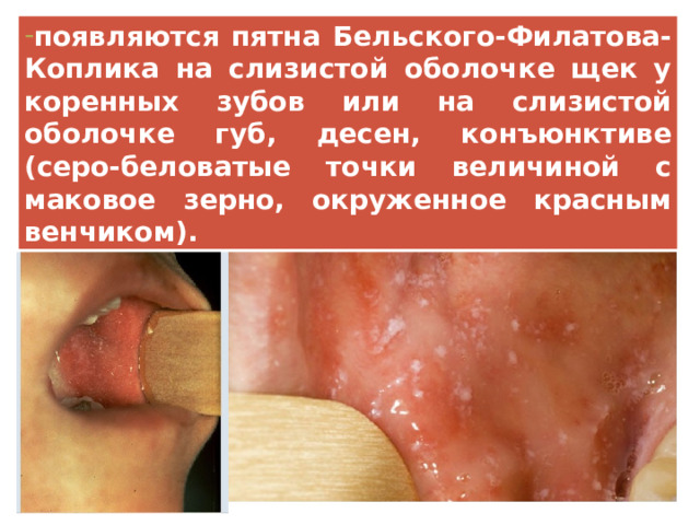 появляются пятна Бельского-Филатова- Коплика на слизистой оболочке щек у коренных зубов или на слизистой оболочке губ, десен, конъюнктиве (серо-беловатые точки величиной с маковое зерно, окруженное красным венчиком). 