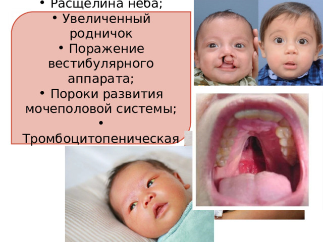  Расщелина нёба;  Увеличенный родничок  Поражение вестибулярного аппарата;  Пороки развития мочеполовой системы;  Тромбоцитопеническая пурпура 