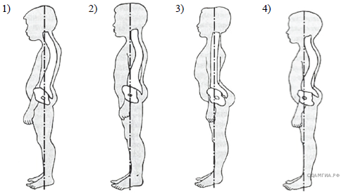 4 рассмотрите рисунки. Рассмотрите рисунок у подростка с нормальной осанкой. Рассмотрите рисунок 1-4 с типом осанки человека. Рассмотрите рисунки 1-4 с изображением типов осанок человека. На каком рисунке изображен подросток с нормальной осанкой.