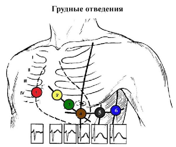 12 канальный холтер схема наложения