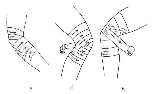 Повязка на локоть схема