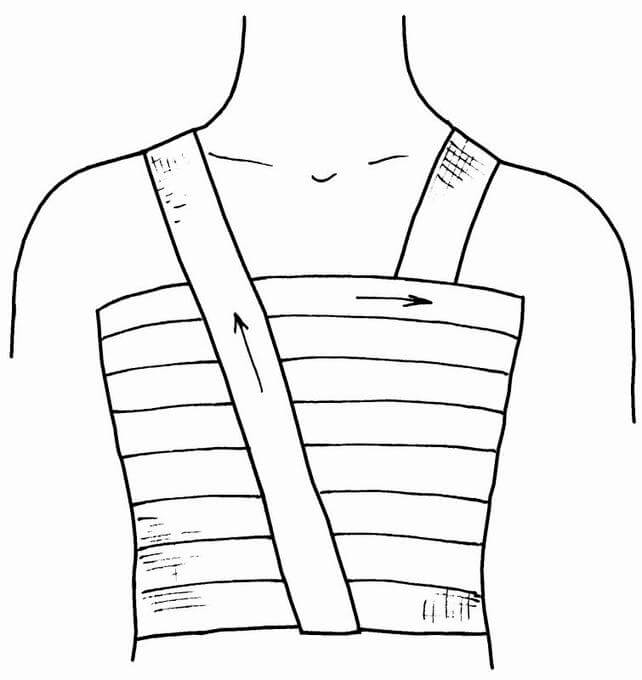 Спиральная повязка на грудную клетку: эффективность и …
