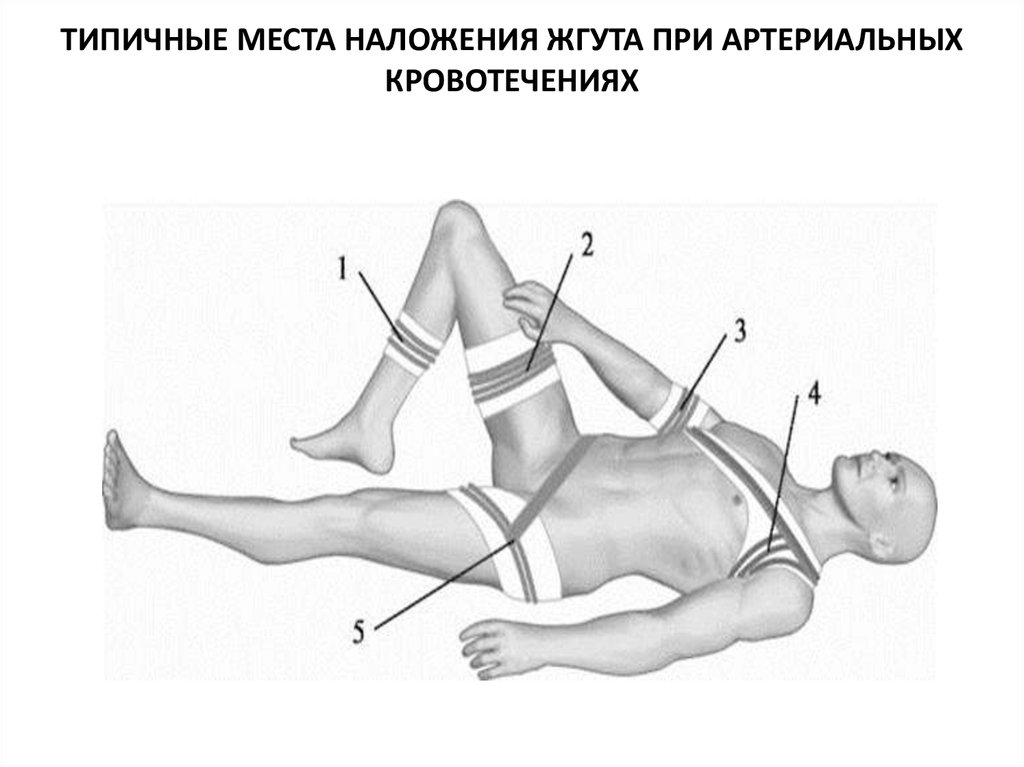 Наложение жгута картинки