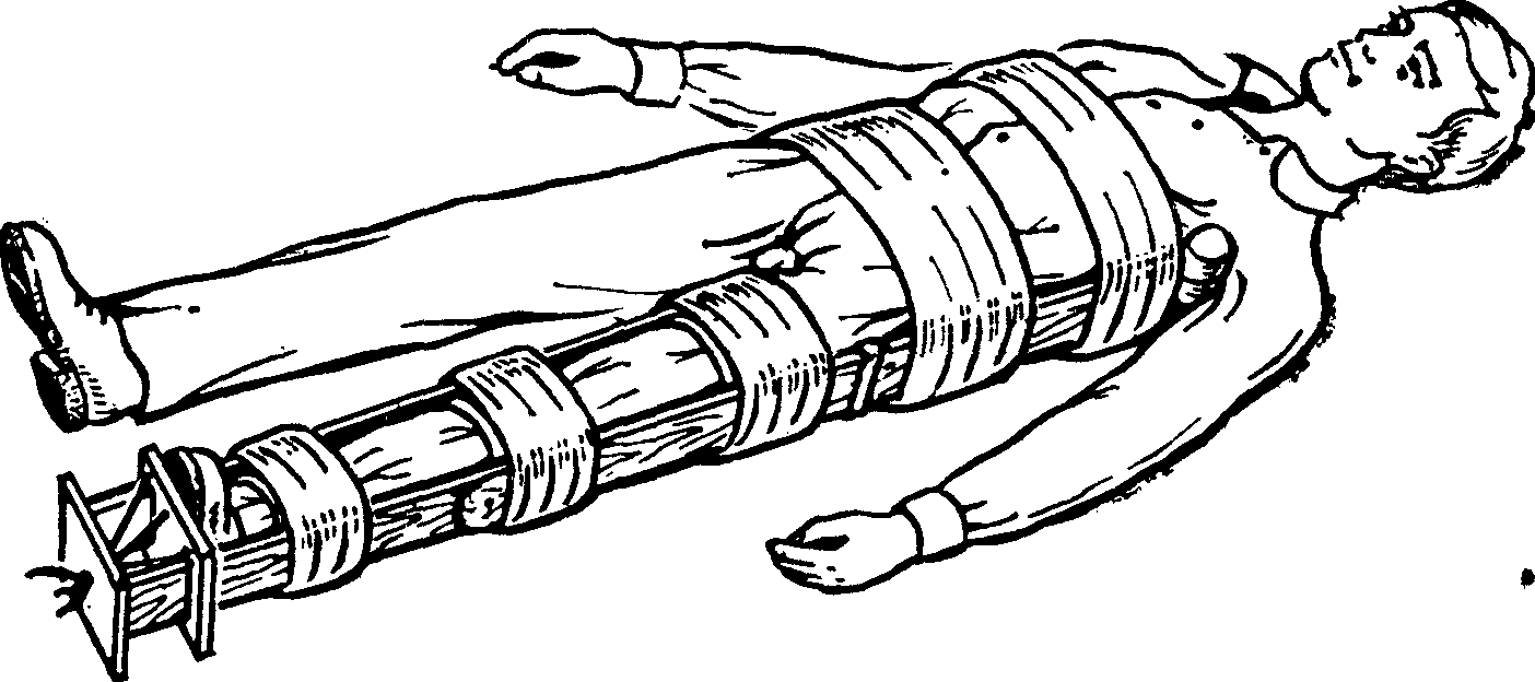 Шейка бедра иммобилизация. Транспортная шина Дитерихса. Иммобилизация шиной Дитерихса. Шинирование при переломе. Наложение шины Дитерихса.