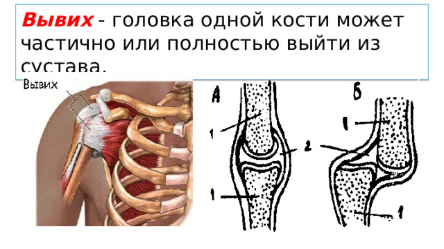 Вывих - головка одной кости может частично или полностью выйти из сустава. Вывих фаланги пальца Вывих коленного сустава 
