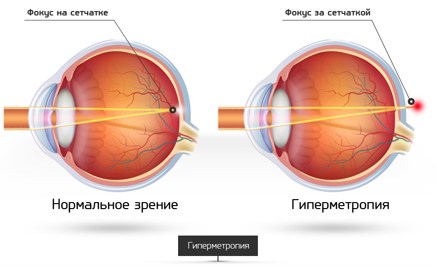 Сложный гиперметропический астигматизм обоих глаз у ребенка. Глазные болезни гиперметропия. H52.0 гиперметропия. Гиперметропия глаза что это такое. Дальнозоркость.