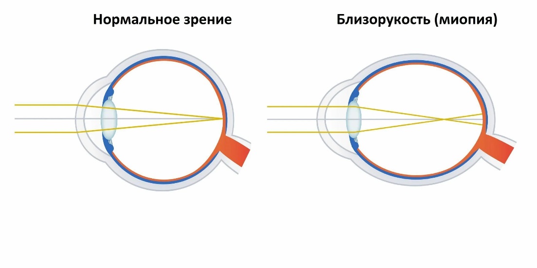 Нарушение зрения двоение изображения латынь