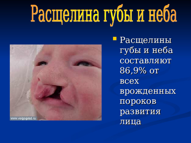 Расщелины губы и неба составляют 86,9% от всех врожденных пороков развития лица  