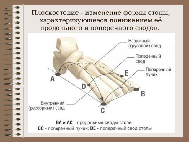 Плоскостопие - изменение формы стопы, характеризующееся понижением её продольного и поперечного сводов. 