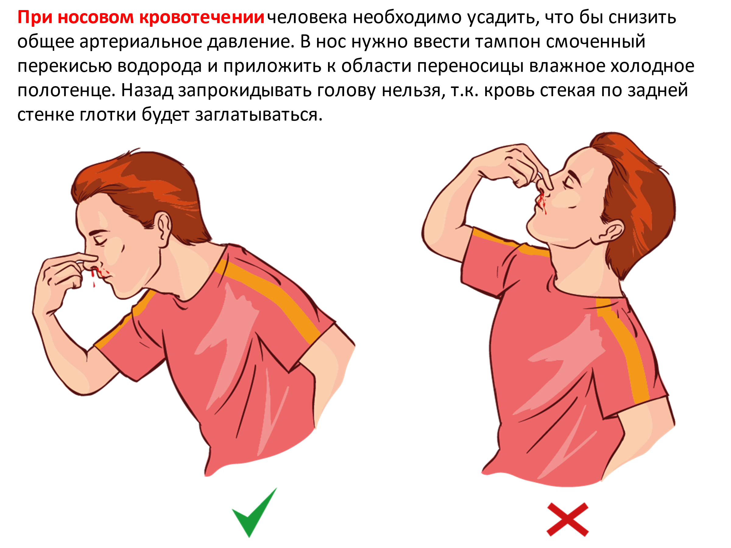 Сморкаюсь с кровью. Нососовое кровотечение. Оказание помощи при кровотечении из носа. Капиллярное кровотечение из носа.