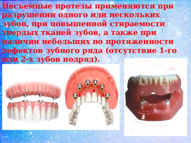 Характеристика несъемных протезов. Несъемные протезы зубов для детей. Несъемное протезирование зубов книга. Протезирование зубов ppt их рай.