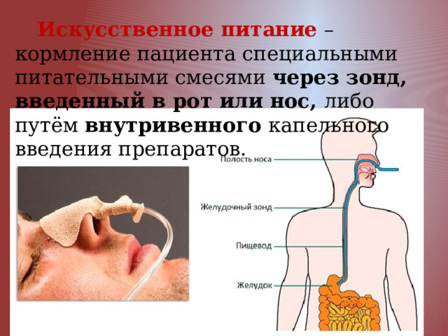  Искусственное питание – кормление пациента специальными питательными смесями через зонд, введенный в рот или нос, либо путём внутривенного капельного введения препаратов. 