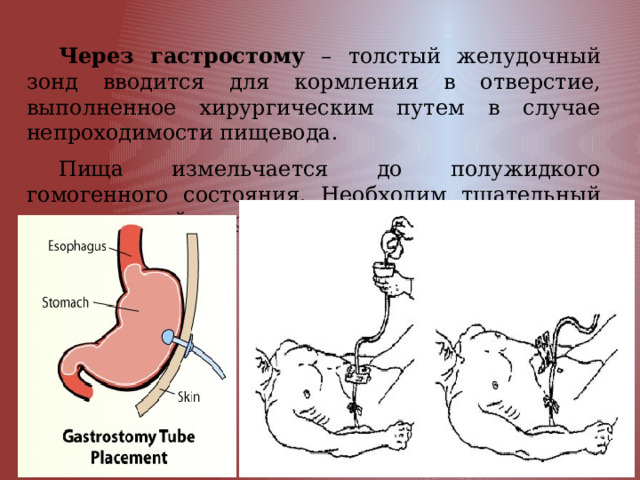 Через гастростому – толстый желудочный зонд вводится для кормления в отверстие, выполненное хирургическим путем в случае непроходимости пищевода. Пища измельчается до полужидкого гомогенного состояния. Необходим тщательный уход за кожей вокруг стомы. 