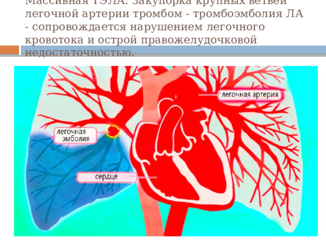 Массивная ТЭЛА. Закупорка крупных ветвей легочной артерии тромбом - тромбоэмболия ЛА - сопровождается нарушением легочного кровотока и острой правожелудочковой недостаточностью. 