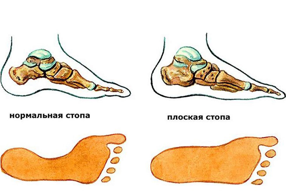 Как выглядит нога с плоскостопием Практикум правильного осанка и плоскостопья.
