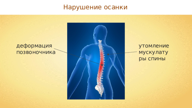 Нарушение осанки деформация позвоночника утомление мускулатуры спины 