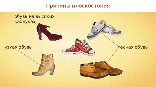 Причины плоскостопия обувь на высоких каблуках тесная обувь узкая обувь 