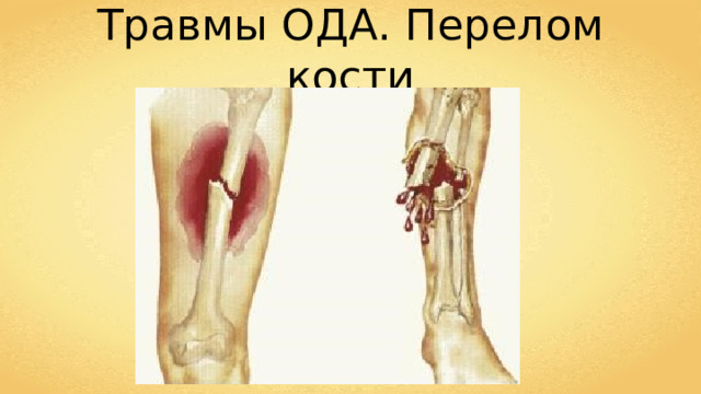 Травмы ОДА. Перелом кости 