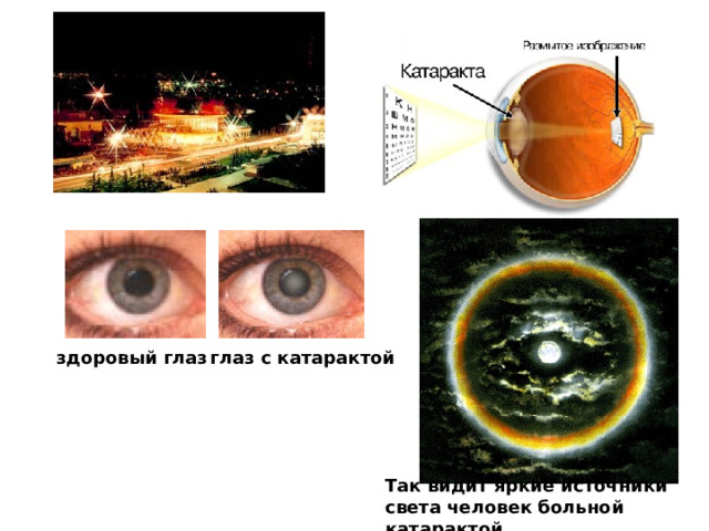 здоровый глаз глаз с катарактой Так видит яркие источники света человек больной катарактой 