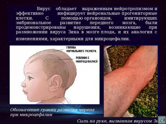  Вирус обладает выраженным нейротропизмом и эффективно инфицирует нейрональные прогениторные клетки. С помощью органоидов, имитирующих эмбриональное развитие переднего мозга, были продемонстрированы нарушения, возникающие при размножении вируса Зика в мозге плода, и их аналогия с изменениями, характерными для микроцефалии.  Обозначение границ развития черепа при микроцефалии 19 Сыпь на руке, вызванная вирусом Зика  