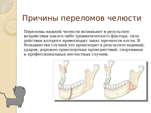 Причины переломов челюсти Переломы нижней челюсти возникают в результате воздействия какого-либо травматического фактора, сила действия которого превосходит запас прочности кости. В большинстве случаев это происходит в результате падений, ударов, дорожно-транспортных происшествий, спортивных и профессиональных несчастных случаев.   